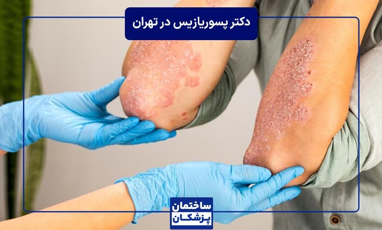 بیماری پسوریازیس چیست؟