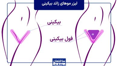 راهنمای جامع لیزر موهای زائد واژن