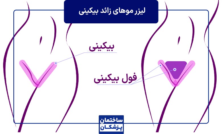 راهنمای جامع لیزر موهای زائد واژن