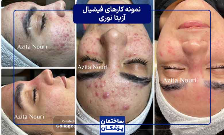 نمونه کارهای فیشیال پوست در کلینیک آزیتا نوری