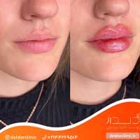 نمونه کار تزریق ژل لب دلدار