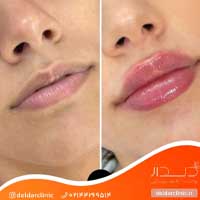 عکس نمونه کار واقعی تزریق ژل لب دلدار