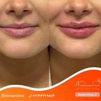 تصویر قبل و بعد از تزریق ژل لب در کلیک دلدار