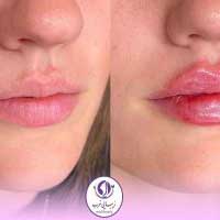 تصویر نمونه کار تزریق ژ لب در کلینیک زیبایی غرب