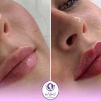 نمونه کار تزریق ژل لب قبل و بعد در کلینیک زیبایی غرب