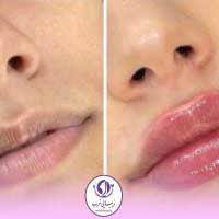 تصویر واقعی از تزریق ژل لب در کلینیک زیبایی غرب