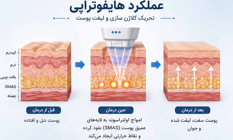 هایفوتراپی چیست