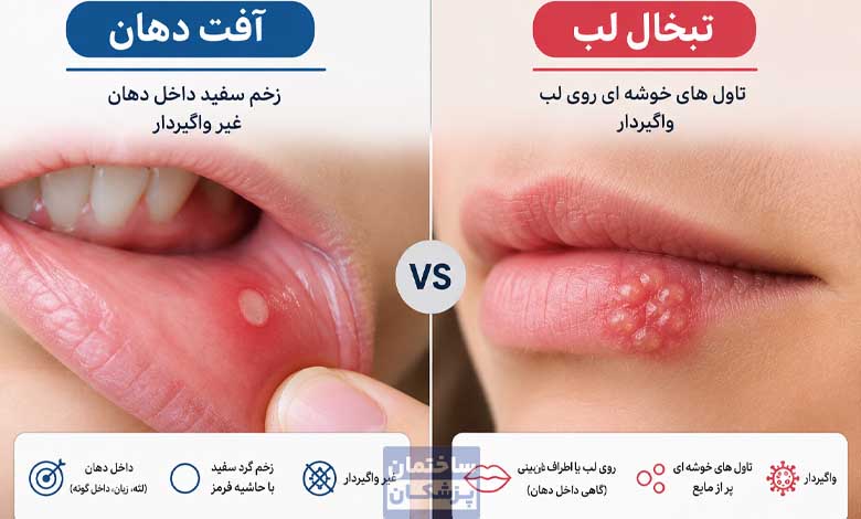 تفاوت تبخال لب و آفت دهان در عکس