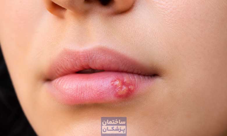 عکس واقعی تبخال لب