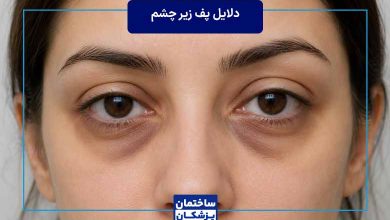 کمبود کدام ویتامین باعث پف زیر چشم می‌شود؟