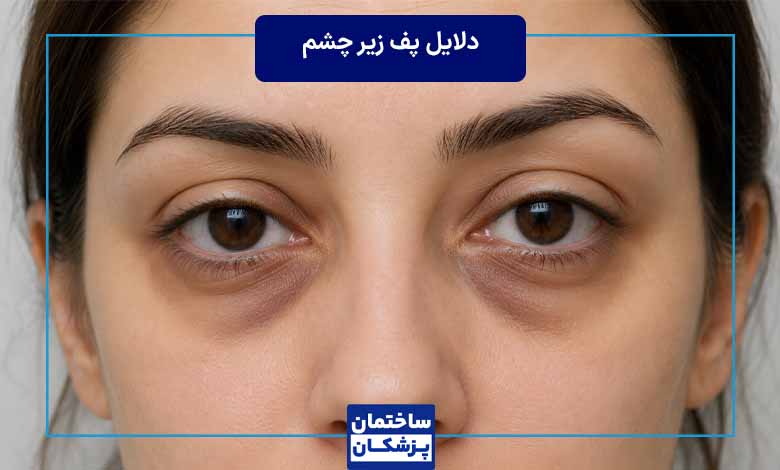 کمبود کدام ویتامین باعث پف زیر چشم میشود؟
