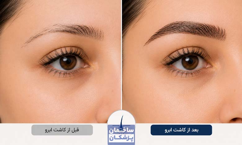 قبل و بعد از کاشت ابرو طبیعی