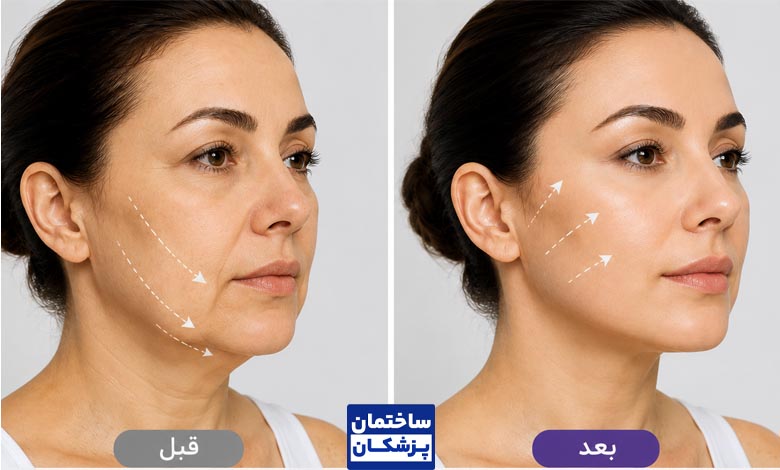 عکس قبل و بعد از لیفت صورت با نخ