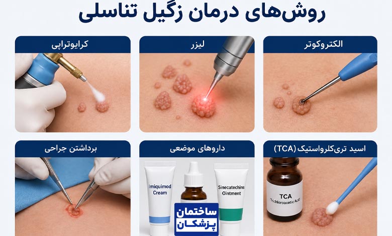 هزینه برداشتن زگیل تناسلی باروشهای مختلف