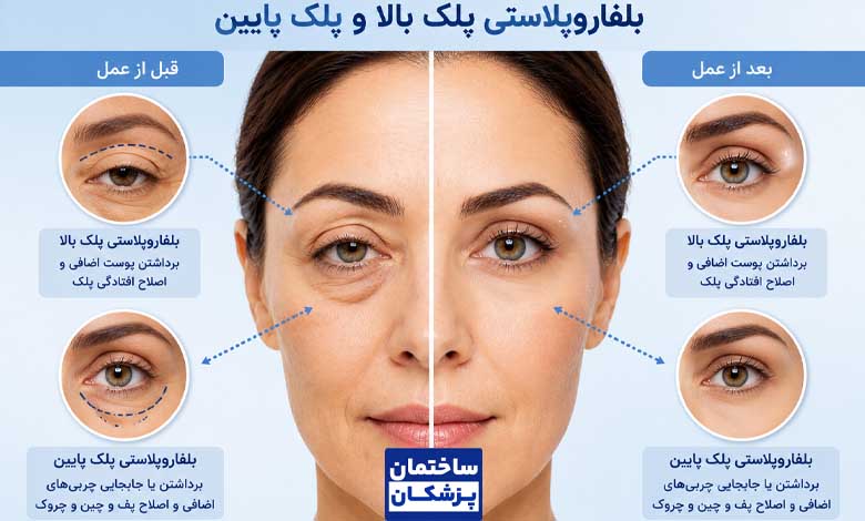 هزینه بلفاروپلاستی پلک بالا و پایین