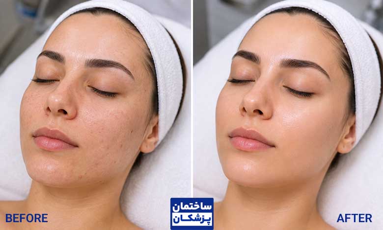 هزينه و قیمت فيشيال عکس فیشیال صورت قبل و بعد