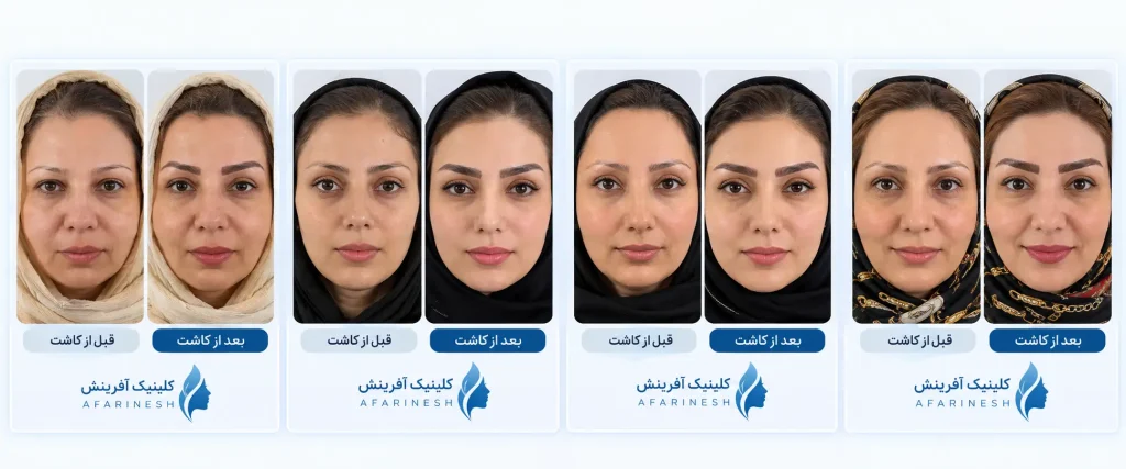 نمونه کارهای کاشت ابرو در کلینیک آفرینش