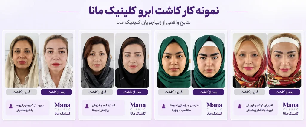 نمونه کار کاشت ابرو قبل و بعد کلینیک مانا
